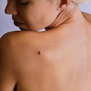 Malign Melanom nedir?